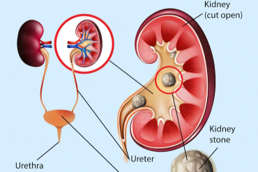 Kidney / Renal Stones